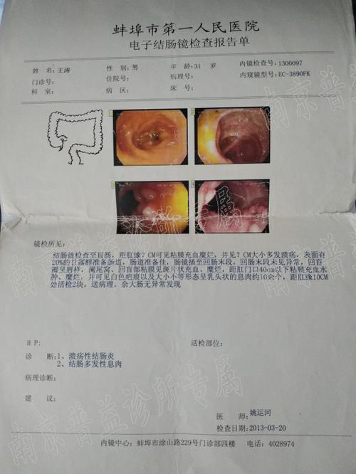 大便无血溃疡性结肠炎