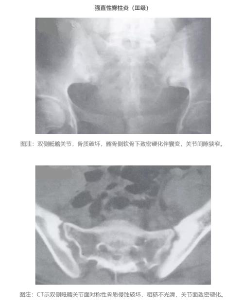 骶髂变性是强直性脊柱炎的前兆吗