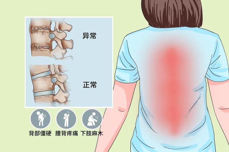 六十岁得强直性脊柱炎