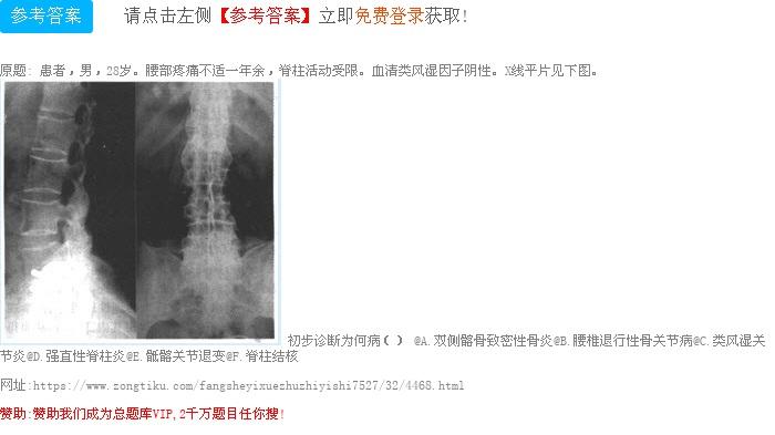 骶髂ct能看出强直性脊柱炎吗