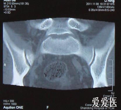 骶髂密度增高是强直性脊柱炎吗