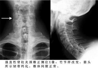 如何判断自己是强直性脊柱炎