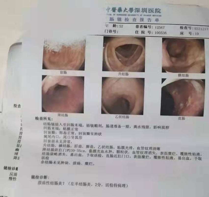 溃疡性结肠炎病人有内痔怎么治疗