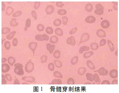 原发性骨髓纤维化