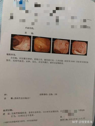 溃疡性结肠炎吃什么食物最好