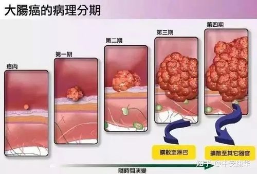 溃疡性结肠炎转癌可能性大吗