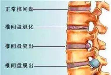 什么坐姿导致强直性脊柱炎