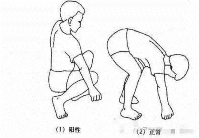 强直性脊柱炎不可以蹲吗