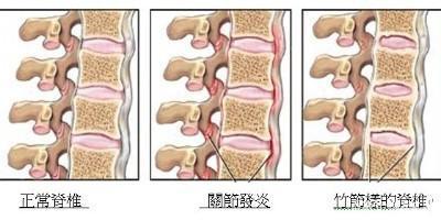 强直性脊柱炎怎么检查有没有遗传