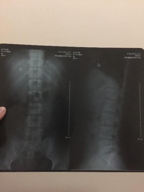 强直性脊柱炎是否会肝肾功能异常