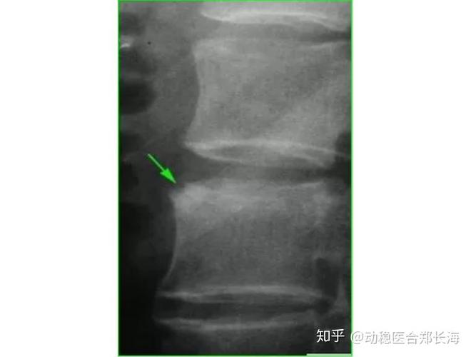 钙多导致强直性脊柱炎