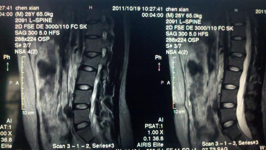 强直性脊柱炎屁股有核磁共振