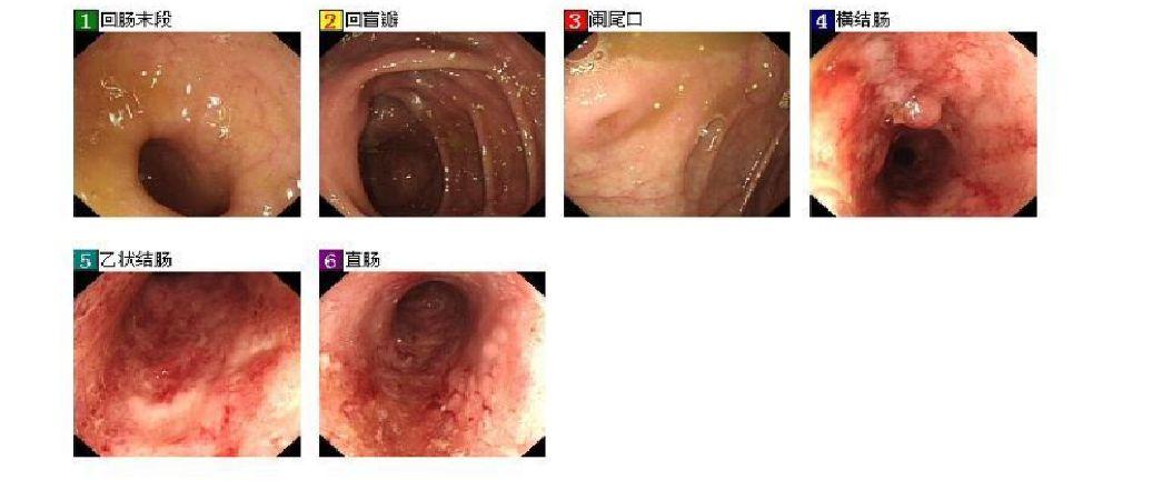 慢性溃疡性结肠炎能喝糖水吗