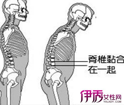 强直性脊柱炎颈椎僵硬是什么期