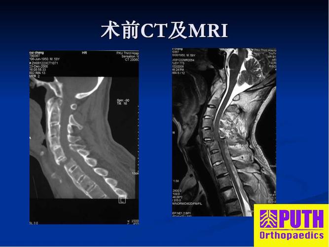 强直性脊柱炎跟颈椎病有关系吗