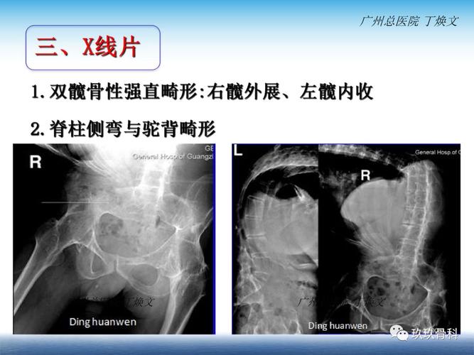 超微粒子能治疗强直性脊柱炎吗