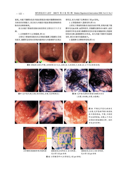 溃疡性结肠炎内镜下分度标准