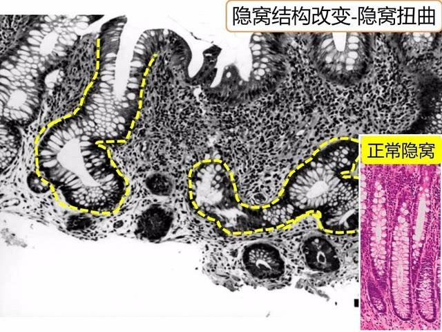 溃疡性结肠炎常见吗