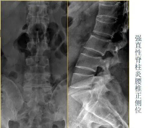 怎样判断强直性脊柱炎