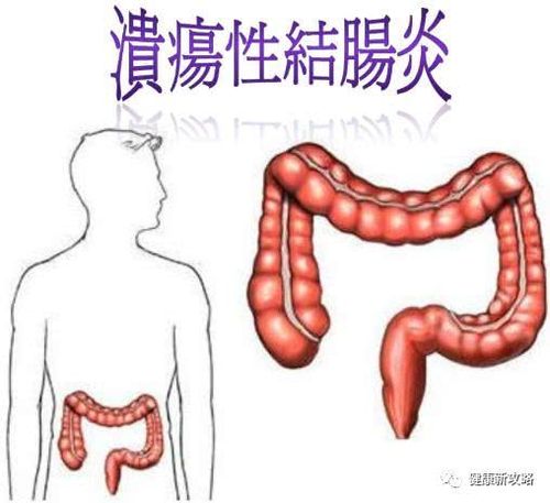 溃疡性结肠炎大便就出血