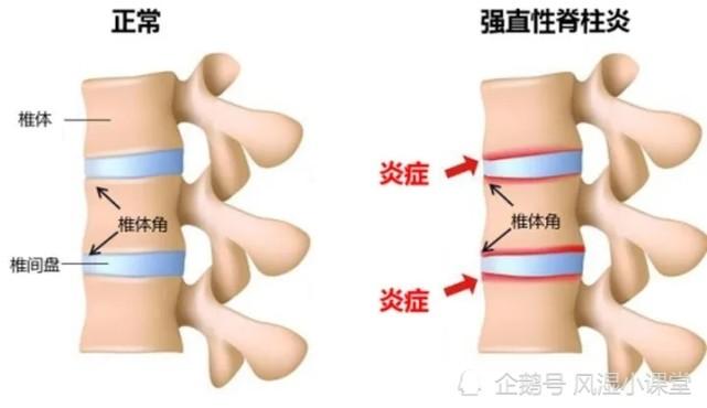 类风湿强直性脊柱炎