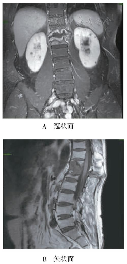 强直性脊柱炎磁共振怎么做