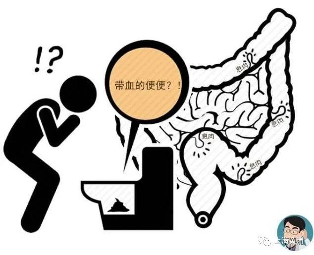 豆腐渣与溃疡性结肠炎