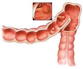肠息肉与溃疡性结肠炎