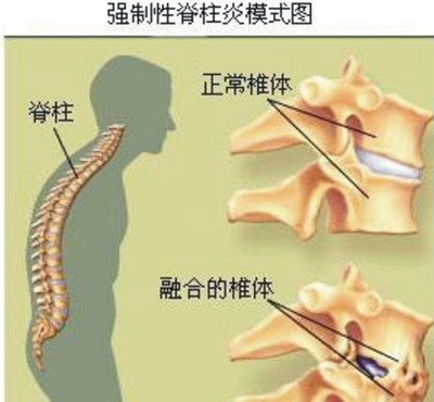 强直性脊柱炎吃什么中成药去炎