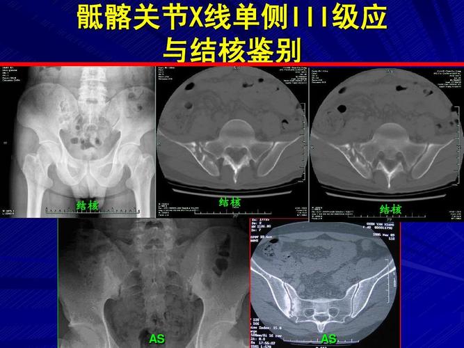 强直性脊柱炎放射治疗有副作用吗