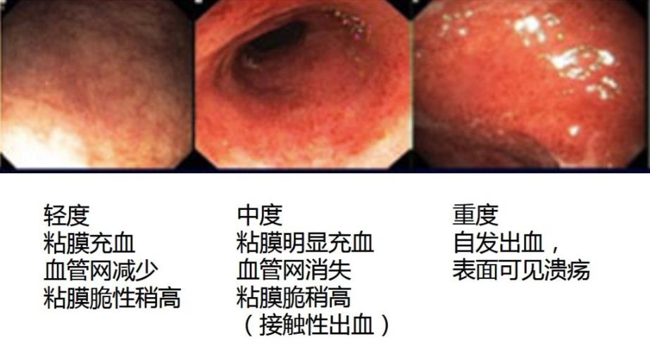 铁树叶对溃疡性结肠炎有效果吗