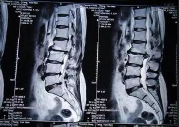 强直性脊柱炎腰椎间盘突出