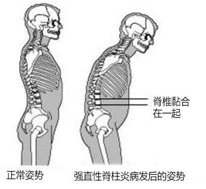 强直性脊柱炎按摩调理