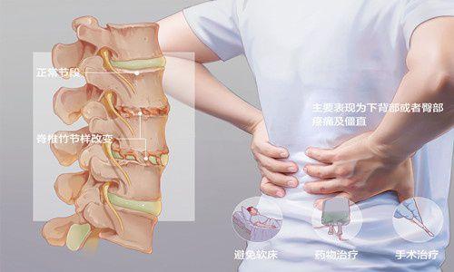 强直性脊柱炎恶心吗消化不好吗