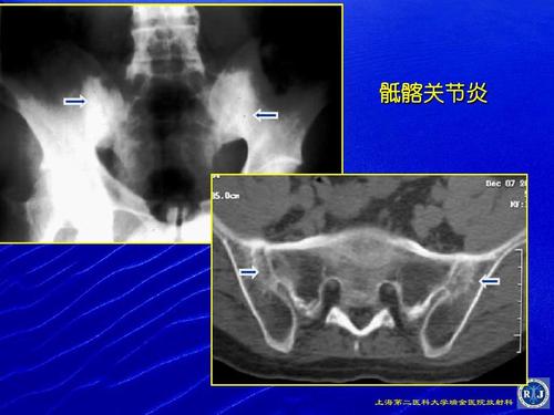 强直性脊柱炎会导致肩关节粘连