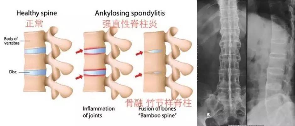 低头后背疼是强直性脊柱炎吗