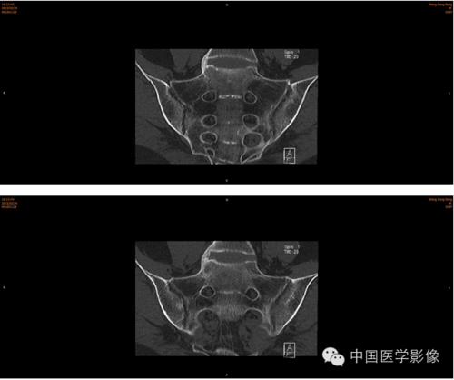 强直性脊柱炎正常是阴性还是阳性