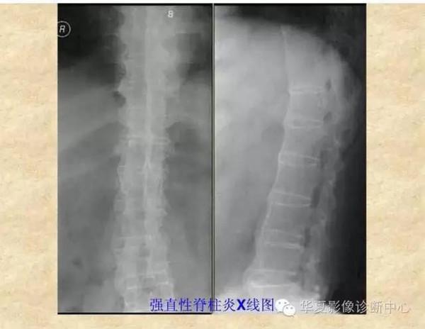 ct强直性脊柱炎