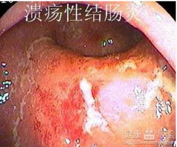 昆明擅长治疗溃疡性结肠炎的医生