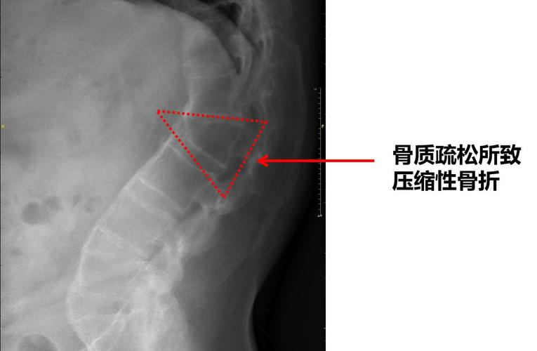 强直性脊柱炎为什么做ppd