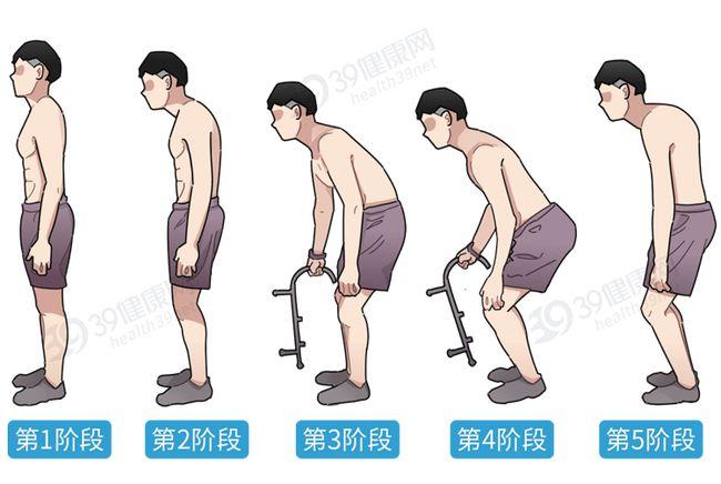 强直性脊柱炎痛到脚肿是什么问题