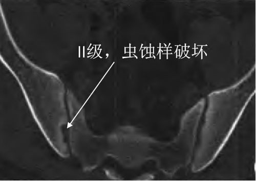 查出强直性脊柱炎严重吗