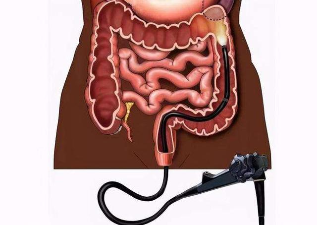 溃疡性结肠炎会导致腹水么