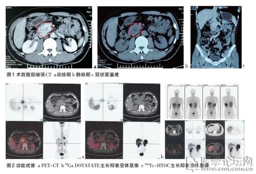 胰腺神经内分泌肿瘤