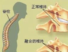 强直性脊柱炎拿药怎么报销