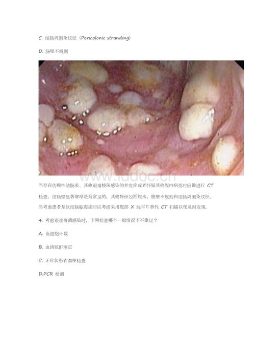 溃疡性结肠炎与肠道厌氧菌