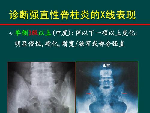 生物制剂治疗强直性脊柱炎