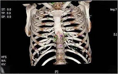 尪痹片治疗强直性脊柱炎案例