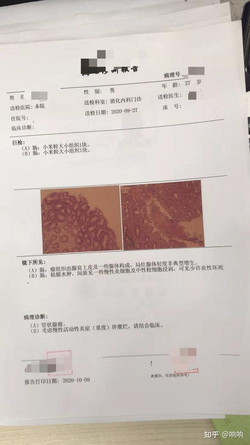 肾虚溃疡性结肠炎