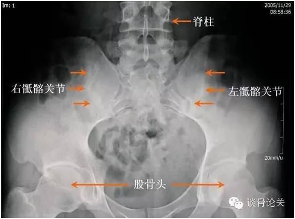 b27一定会得强直性脊柱炎吗